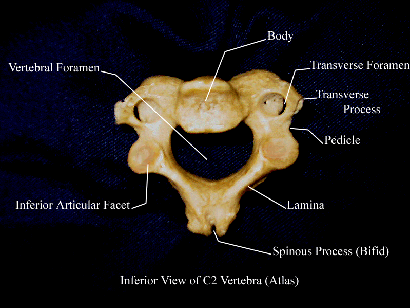 a labeled picture of an inferior view of the second cervical vertebra