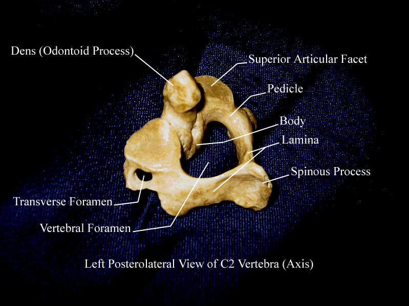 a labeled picture of the second cervical vertebra from a posterior lateral view