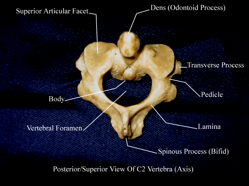 a labeled picture of the second cervical vertebra from a superior view