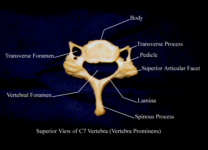 a labeled picture of the seventh cervical vertebra from a superior view