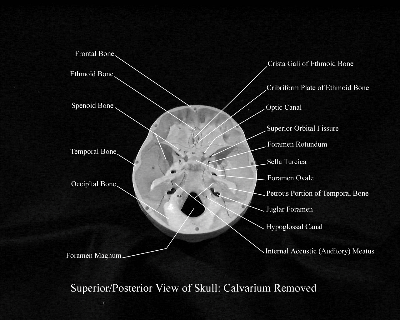 a labeled picture of a superior posterior view of a skull with the calvarium removed