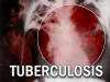Tuberculosis poster